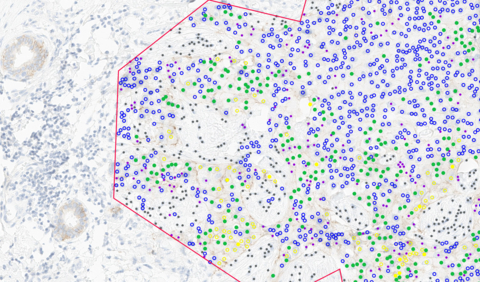 original Ibex's HER2 breast cancer biomarker scoring solution