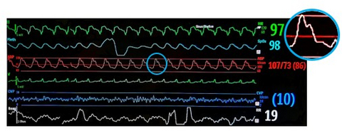original The vital signs of the patient with physiological pulsatility are shown in this picture.