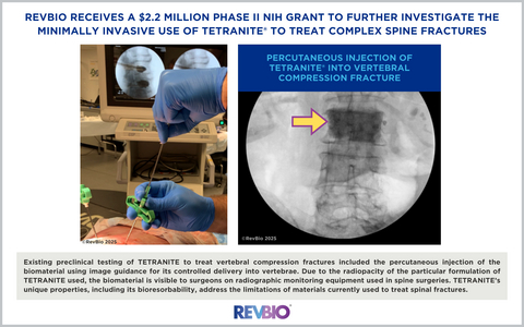 Existing preclinical testing of TETRANITE to treat vertebral compression fractures included the percutaneous injection of the biomaterial using image guidance for its controlled delivery into vertebrae. Due to the radiopacity of the particular formulation of TETRANITE used, the biomaterial is visible to surgeons on radiographic monitoring equipment used in spine surgeries. TETRANITE’s unique properties, including its bioresorbability, address the limitations of materials currently used to treat spinal fractures.
