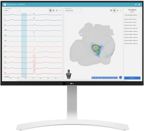 original vMap is a non-invasive tool developed with AI that transforms standard 12-lead ECG data into 3D arrhythmia source maps in under a minute.