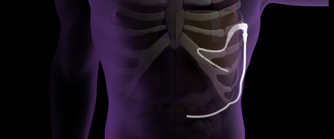 original The ACES™️ Automatic Continuous Effusion Shunt for recurrent pleural effusions.