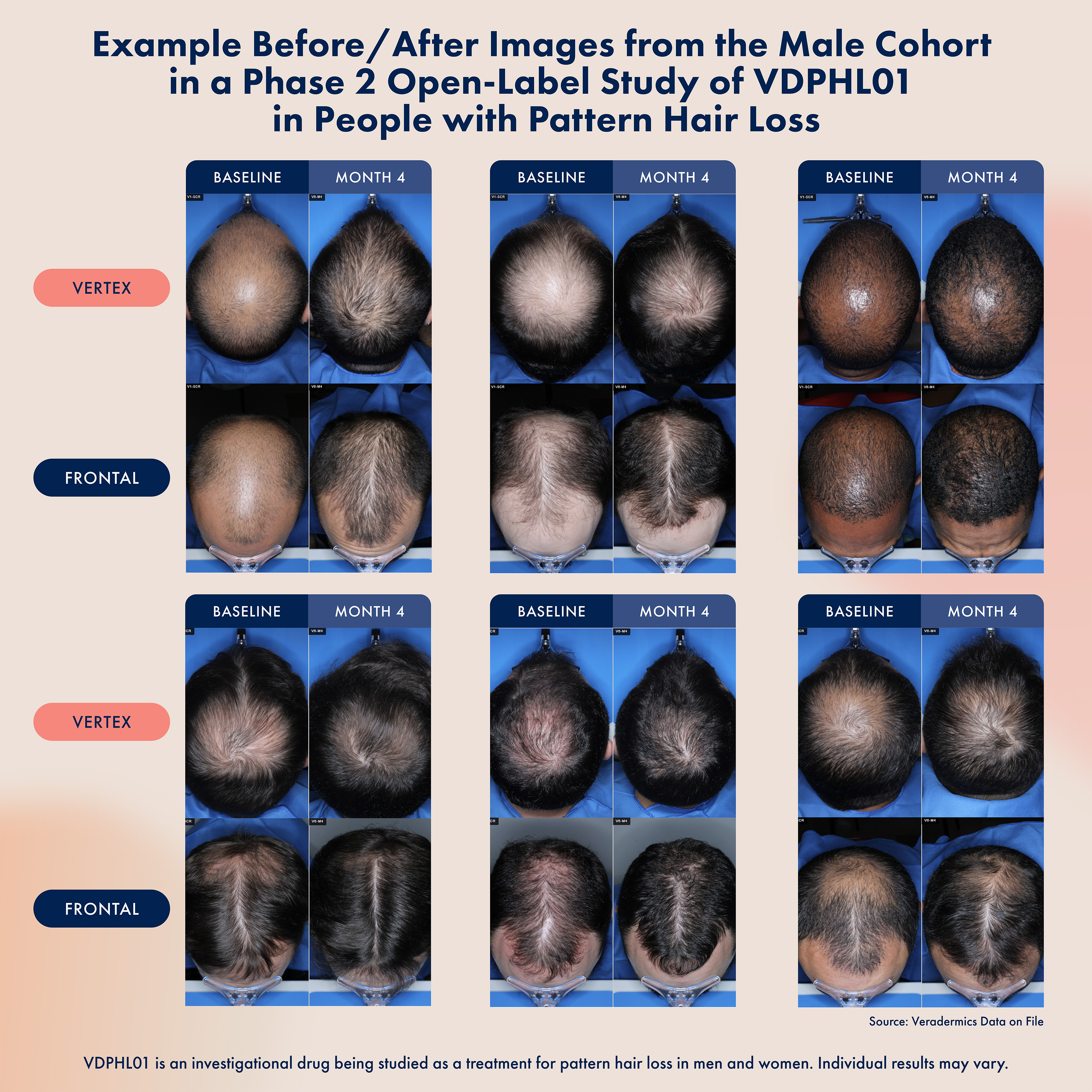 Veradermics Announces Oversubscribed $150 Million Series C