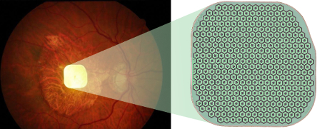 original Pictured above: Photography of the PRIMA implant implanted in the human retina (left) and enlarged to show detail (right). The PRIMA implant (bright light in the center) is 2 × 2mm wide (about the size of a pinhead) and 30µm (microns) thick—which is half the thickness of a human hair.