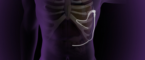 Unlike current approaches that require frequent outpatient drainage through an externalized catheter or prolonged hospitalization for invasive pleurodesis procedures, Pleural Dynamics' Automatic Continuous Effusion Shunt (ACES) device is designed to automatically drain pleural fluid to the peritoneum using the patient’s natural breathing motion, eliminating the need for additional hospital stays for pleural effusion management.