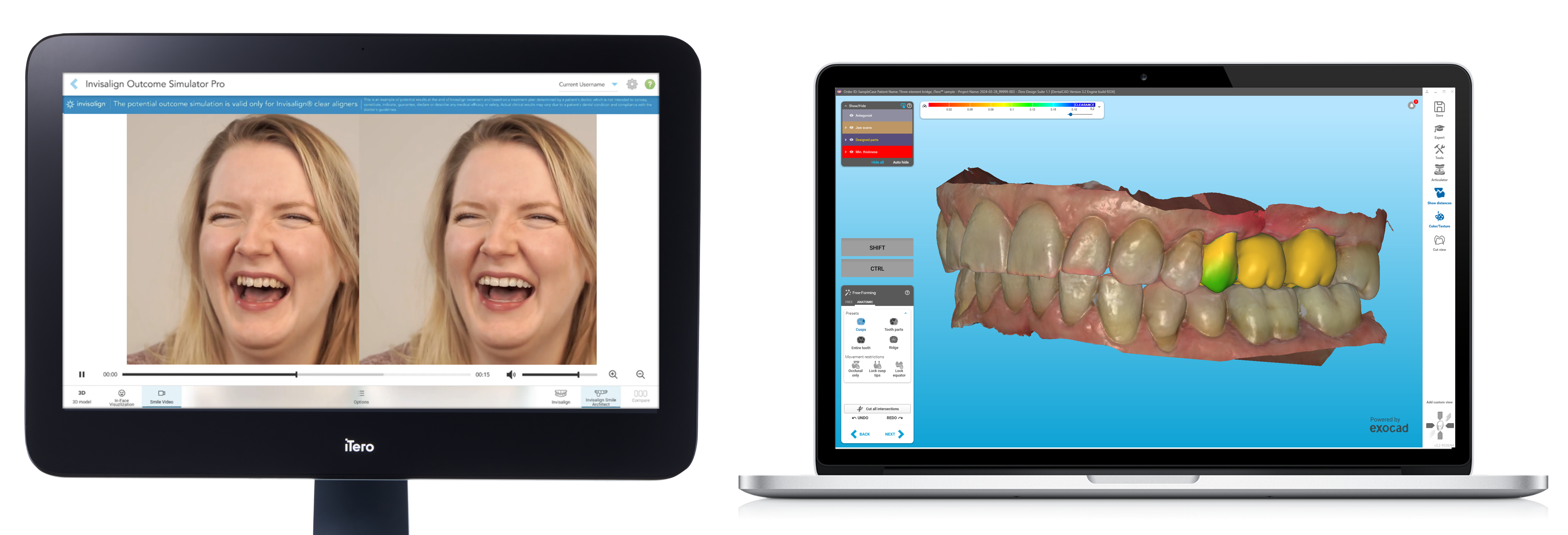 Align Technology Announces New Innovations for iTero™ Digital Solutions ...