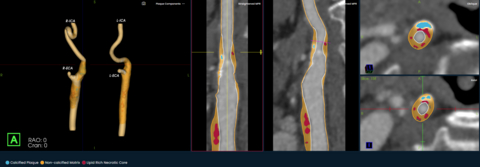 The Elucid PlaqueIQ interactive clinician interface showing assessment of the carotid artery. Source: Elucid.