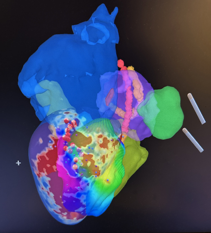 thumbnail Imricor’s NorthStar® Mapping System