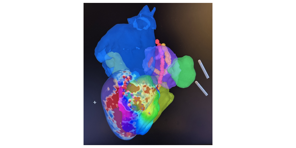  Eseguito con successo il primo intervento di ablazione della TV ischemica in un paziente umano con iCMR