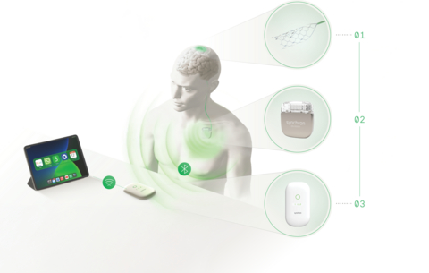 thumbnail An overview of Synchron's BCI system and how it allows users with motor impairment to control their digital devices. (Image credit: Synchron)