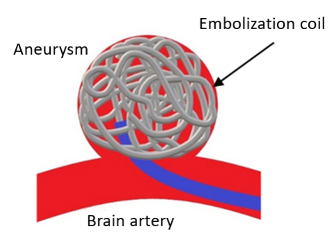 thumbnail Embolization coil