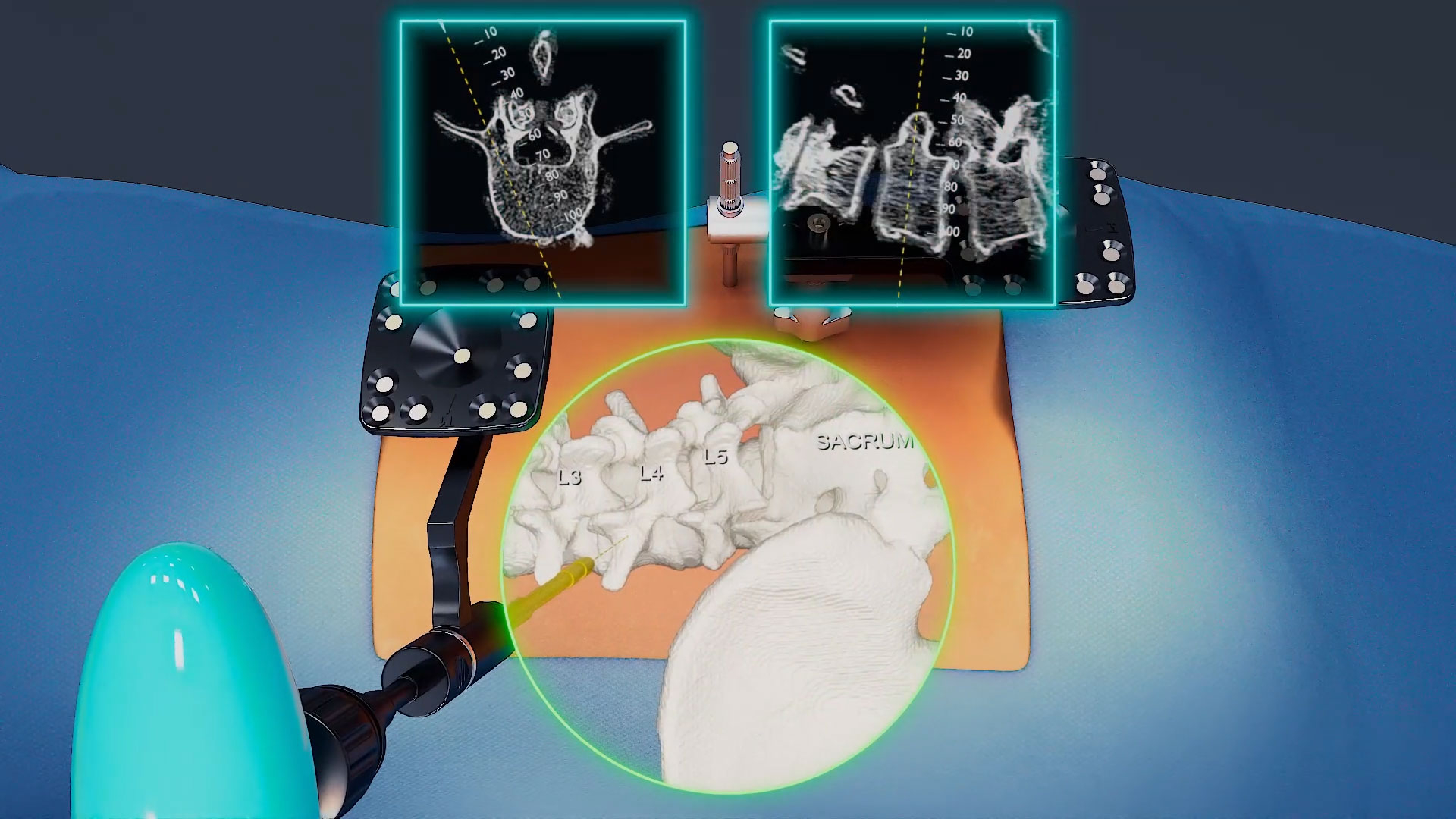 thumbnail Augmedics’ proprietary X2 headset is purpose built for surgery and delivers advanced AR visualization. Credit: Augmedics