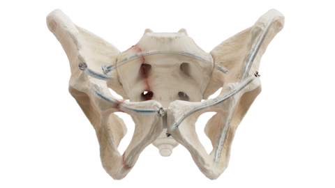 The CurvaFix® System is purpose-built to expand surgical options in challenging fracture scenarios, including curved or narrow pelvic corridors, pathological bone, intersecting fixation pathways, and indwelling and adjacent hardware.