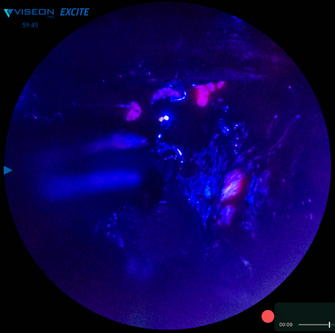 thumbnail Tumor fluorescence using Hubble EXCITE blue light. The violet highlighted tissue is residual glioblastoma tumor.