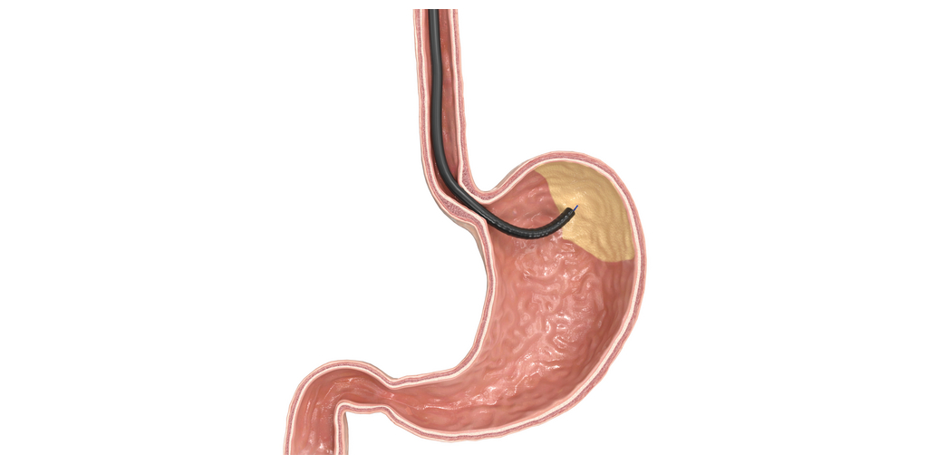  GMA con MOVIVA®: nuovi standard nel trattamento bariatrico endoscopico
