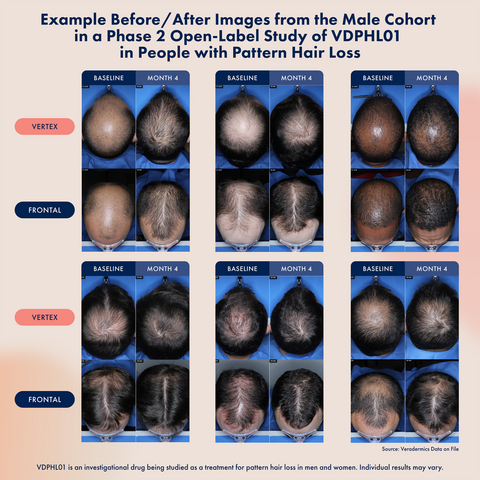 Image of subjects from preliminary Phase 2 readout shared by Veradermics in October