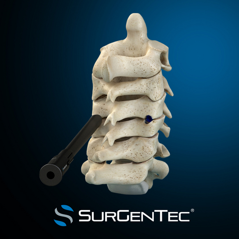SurGenTec® secures FDA clearance for the ION-C™ Facet Fixation System.