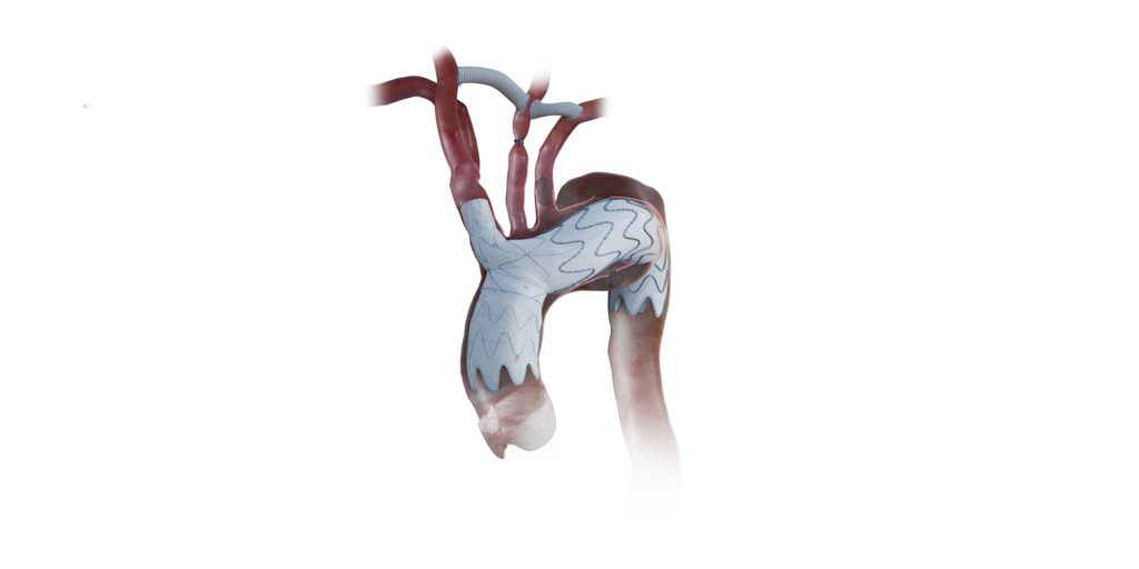 Endospan Receives FDA Approval for the NEXUS® Aortic Arch Stent Graft System 1 Final Graft Image