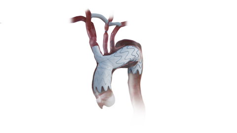 NEXUS Aortic Arch Stent Graft