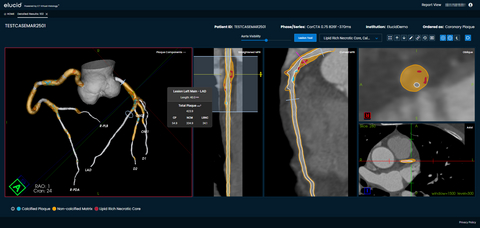 Elucid's new Lesion Inspection Tool for coronary and carotid plaque analysis in its Plaque-IQ software suite provides physicians the ability to interrogate lesion-specific composition and plaque burden across any vessel.