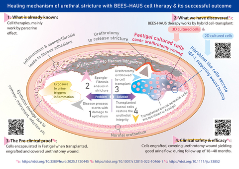 original Urethral stricture starts with narrowing of a short segment of urethral lumen. At early stages, it is managed by balloon dilatation or DVIU Urethrotomy. The open urethrotomy wound after dilatation or DVIU has to heal from the edges of the wound, which may take a longer time. In BEES-HAUS cell therapy, the cell transplant having proven successful engraftment, covering the urethrotomy wound, yielding clinical safety and efficacy may be considered to be included in the treatment guidelines after validation. Its simplified version, the BHES-HAUS (Buccal epithelium Hashed and Encapsulated in Scaffold—Hybrid Approach to Urethral Stricture) accomplished in one-go without need for cell culture in a lab, works on similar principles. After long term follow-up, BHES-HAUS minimally invasive approach may be worth combining with DVIU and balloon dilatation, as it may be able to provide longer duration of recurrence-free, good quality of life without need for intermittent self-catheterization.