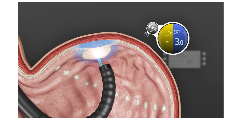 MOVIVA® launch spotlight at ESGE Days 2026 1 MOVIVA GMA Ablation