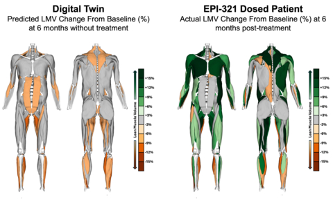 Image caption: MRI images of Lean Muscle Volume (LMV) change from baseline at 6 months for the predicted digital twin without treatment (left) and actual EPI-321 treated patient (right) 6-months post dosing. Images show LMV was predicted to decline due to natural FSHD disease progression (orange colored muscles), but LMV was observed to increase (green muscles) following EPI-321 treatment. Images are from one participant in the study, however the increase in LMV seen here was observed across all n=3 patients 6-months post dosing. Images from Springbok Analytics.