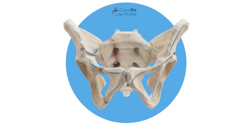 Surgeons to Present Real-World Performance Data from First 3,800 CurvaFix Implants at Orthopaedic Trauma Association Annual Meeting 1 Press Release Image2