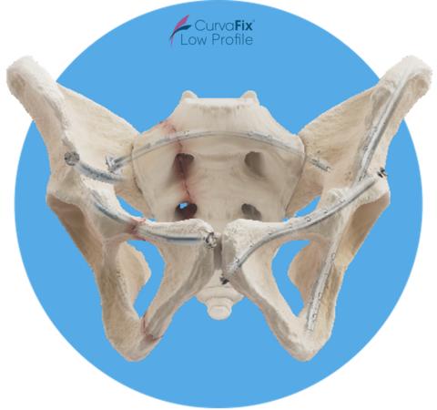 Orthopedic trauma surgeons will present real-world performance data from the first 3,800 CurvaFix implants and review recently published clinical experience with the technology at the 42nd Annual Orthopaedic Trauma Association meeting, Sept. 24, 7:00 am CDT in Exhibit Hall Theater 2, Music City Center, Nashville.
