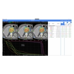 Radformation_OptiPlan_Pancreas.jpg