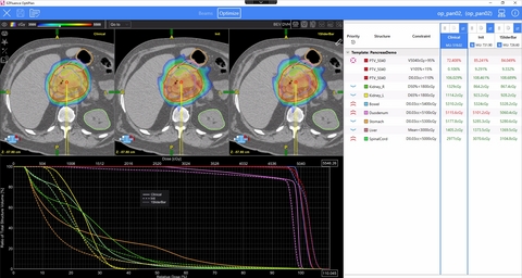 original Pancreas plan comparison: OptiPlan enables side-by-side comparison of dose distributions, DVHs, and constraint results to support informed plan selection.