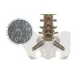 Xenix Medical Announces FDA Clearance of the Riva® Anchor Spinopelvic Fixation System with NanoACTIV™ Surface Technology 2 Riva Anchor NanoACTIV rotating