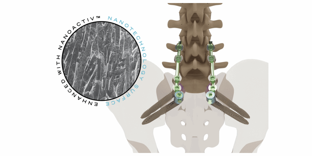 Xenix Medical Announces FDA Clearance of the Riva® Anchor Spinopelvic Fixation System with NanoACTIV™ Surface Technology 1 Riva Anchor NanoACTIV rotating
