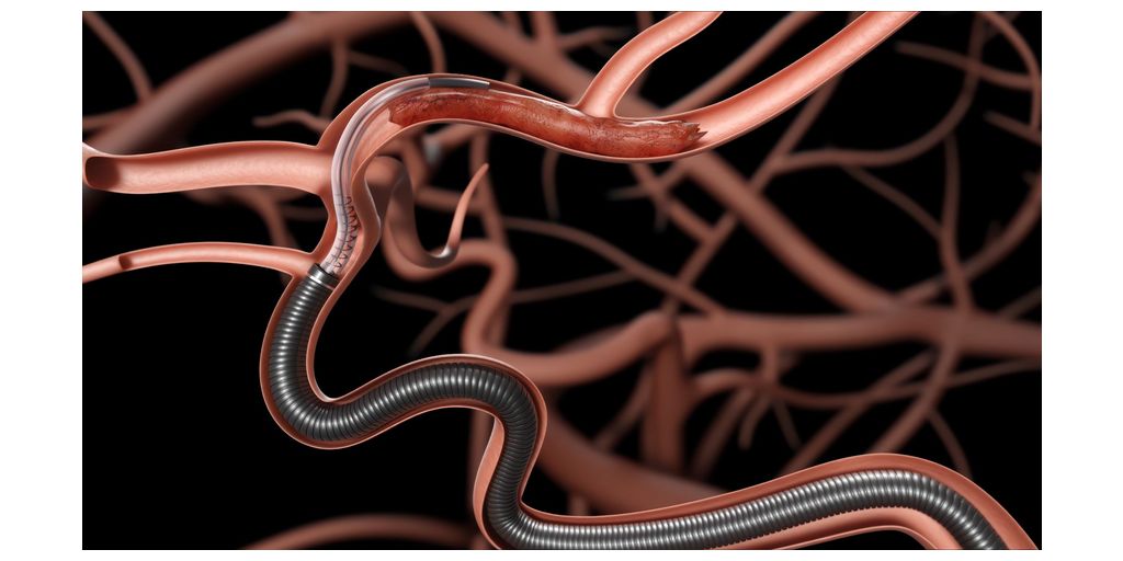 New In-Vitro Study Finds Millipede88 with Corrugated Technology Outperformed Cyclic and Conventional Aspiration 1 Millipede88%C2%AE Super Bore Aspiration Catheter%2C delivered with the Zipline88%C2%AE Access Catheter%2C positioned at the site of occlusion