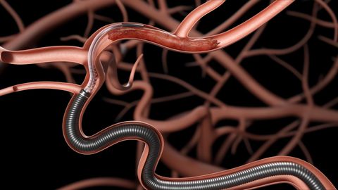 thumbnail Millipede88® Super-Bore Aspiration Catheter, delivered with the Zipline88® Access Catheter, positioned at the site of occlusion. (Illustration; not clinical imagery).