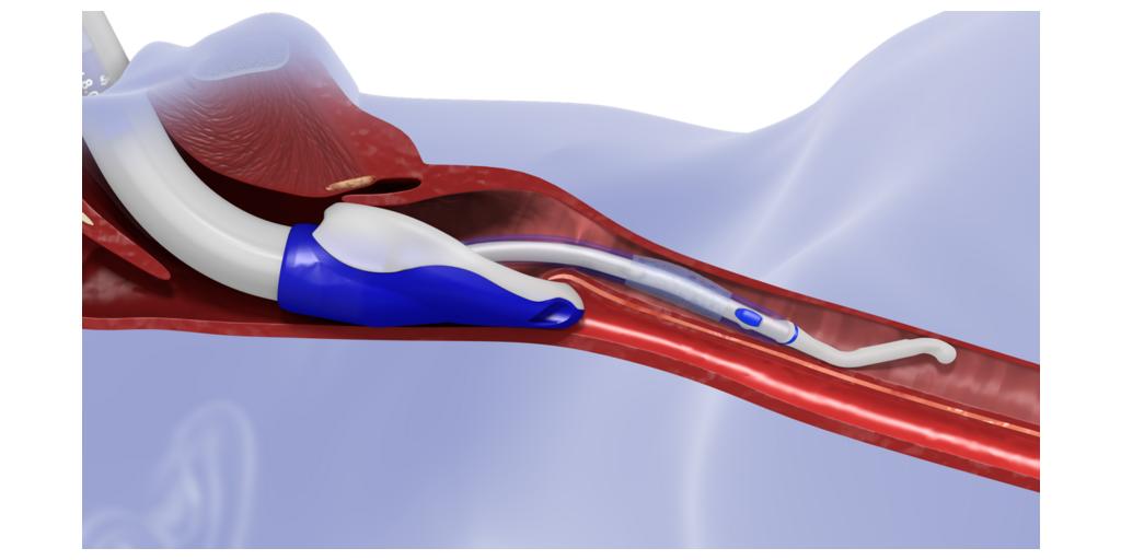 Gardner Medical Instruments Receives FDA Registration for Ventubation™ System and Nomination for EMS EXPO Innovation Award 1 Ventubation SV%2BIG%2BETT insitu 9K v1