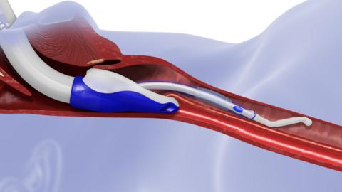 original The Ventubation™ System in the airway.