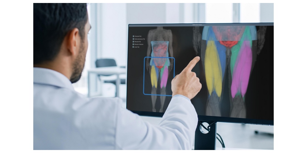 Advanced MRI Imaging Reveals Changes in Muscle Composition and Fat Infiltration During Obesity Treatment 1 AMRA sr0kyjsr0kyjsr0k Mockup 260930 News %283%29