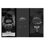 MRI_NextMR_and_CT_Comparison_Lumbar_Spine_Sacrum_Axial_Plane.jpg