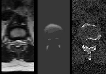 thumbnail MRI, NextMR, and CT Comparison - Lumbar Spine & Sacrum - Axial Plane. Male, 35 yr old; From left to right: MRI T2-Weighted | Slice Thickness 3 mm | Slice Spacing 3.9mm, NextMR Slice Thickness 1mm, CT Slice Thickness Scan 0.6mm