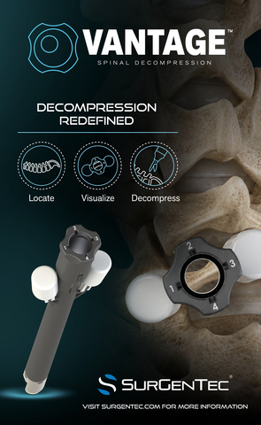 thumbnail SurGenTec® Enters Exclusive License Agreement with Allevion Medical for Vantage™ Spinal Decompression System