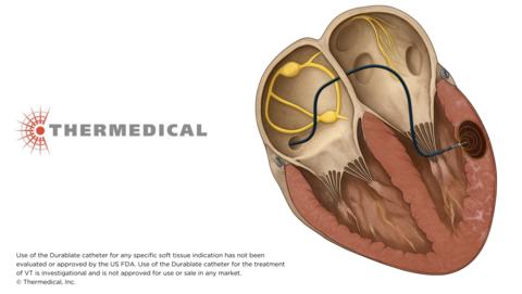 original Thermedical® announces members of the independent data safety monitoring board (DSMB), clinical events committee (CEC), and arrhythmia core lab overseeing its pivotal clinical study of the Saline Enhanced Radiofrequency (SERF) Ablation System with the Durablate® Catheter. The nine experts include eight electrophysiologists and a biostatistician from leading academic medical centers in the U.S. and Canada. Early results from the pivotal study will be presented Oct. 9 at VT Symposium 2026 in Brooklyn.