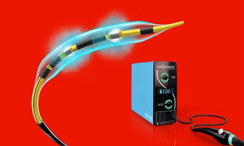 The Shockwave™ C2 Aero Fly Coronary IVL Catheter delivers pulses at 2 Hz, cutting IVL treatment time in half.