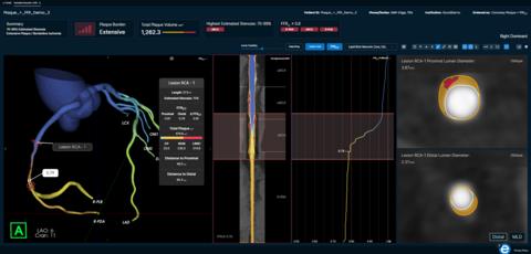Elucid’s FFR-IQ™ and Plaque-IQ™ are featured in its reporting, which integrates coronary anatomy, physiology and plaque biology from a single CCTA